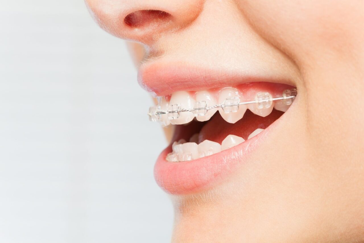 Orthodontist in Bakersfield Superior Smiles Dentistry