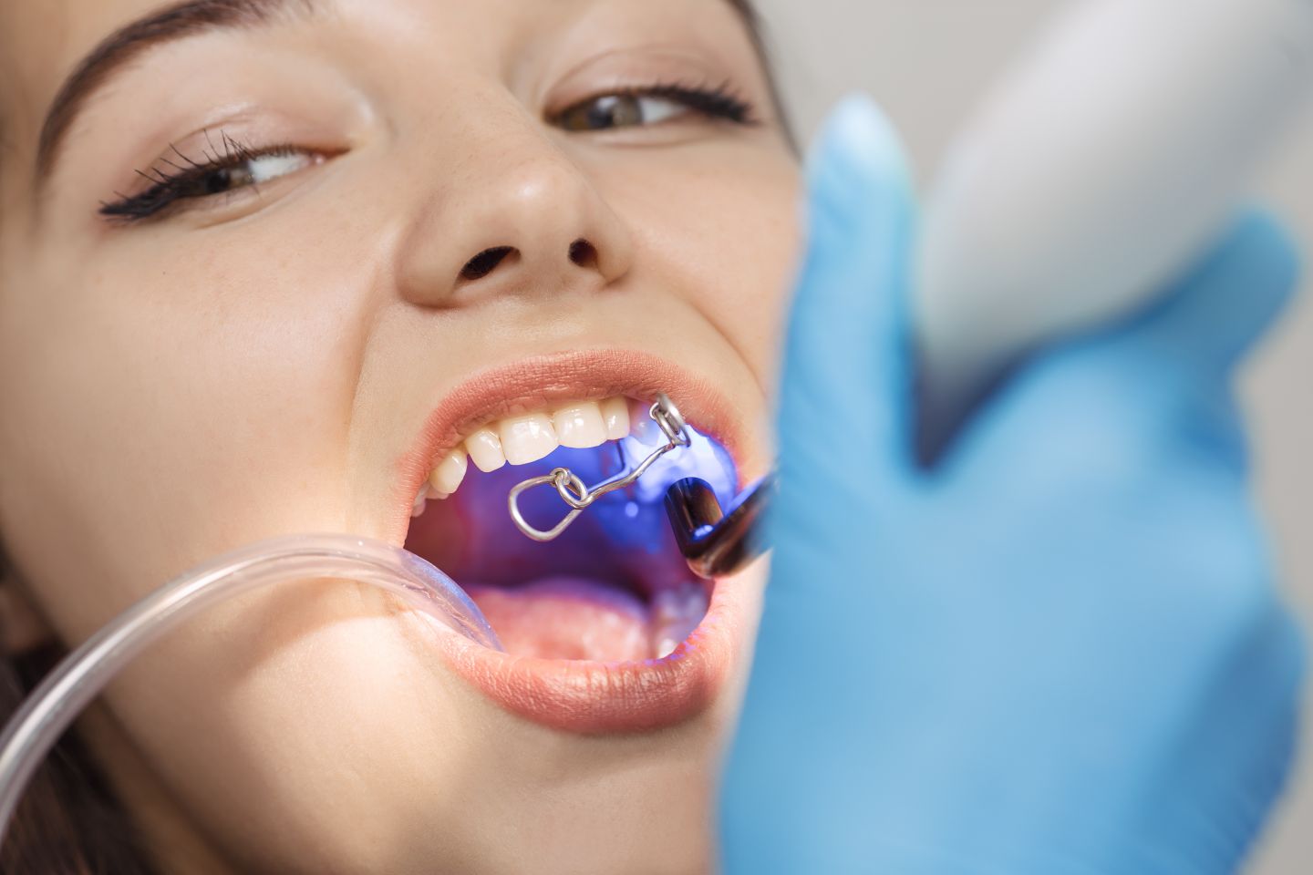 dentalbondinginbakersfieldca1.jpg